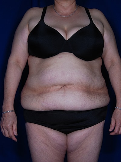 Liposuction Before & After