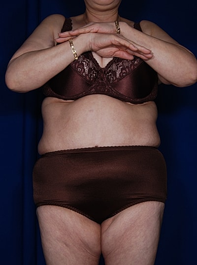 Liposuction Before & After