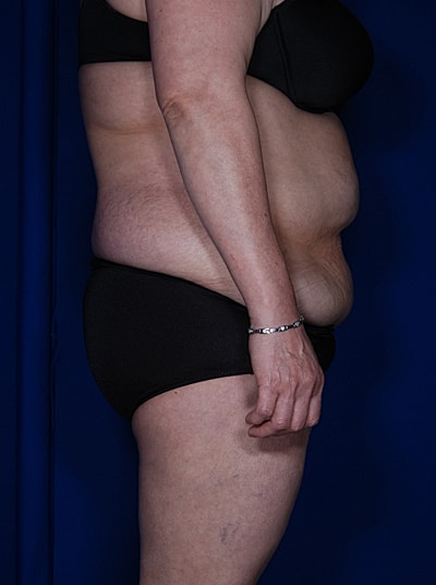 Liposuction Before & After