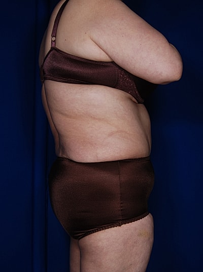 Liposuction Before & After