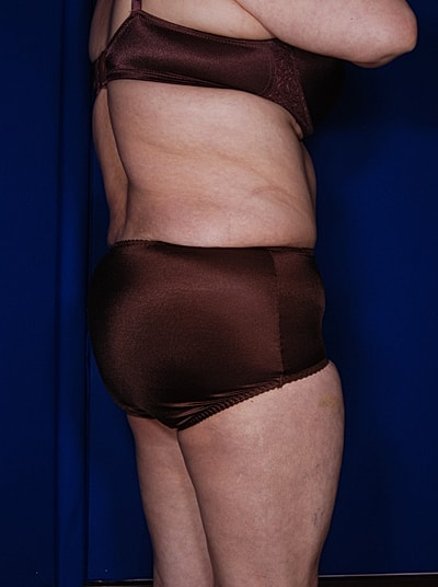 Liposuction Before & After