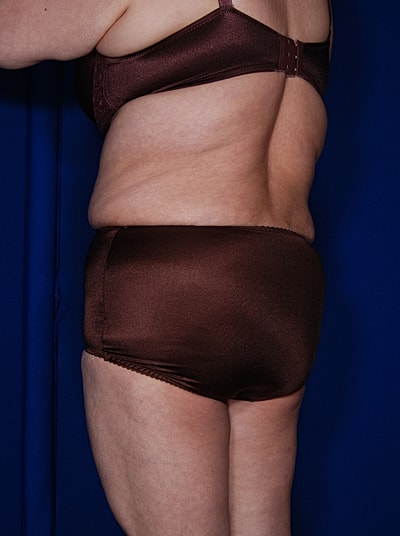 Liposuction Before & After