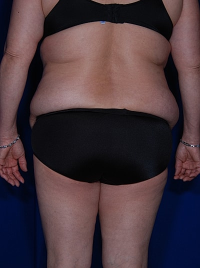 Liposuction Before & After