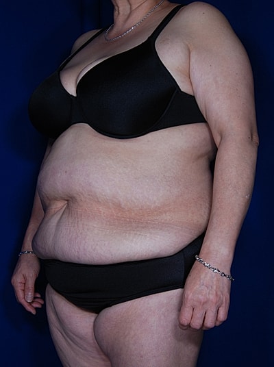 Liposuction Before & After