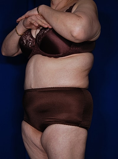 Liposuction Before & After