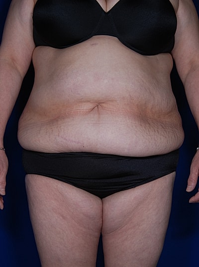 Liposuction Before & After