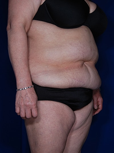 Liposuction Before & After