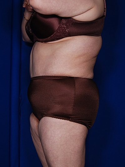 Liposuction Before & After
