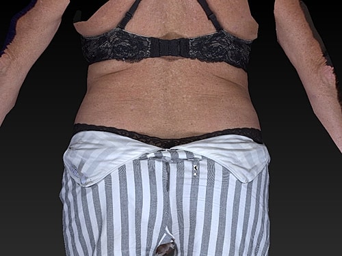 Coolsculpting Before & After
