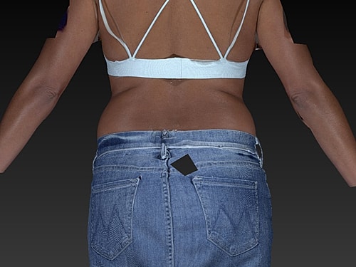 Coolsculpting Before & After