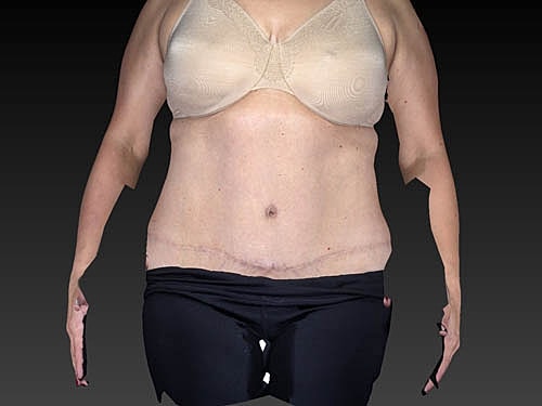 Coolsculpting Before & After