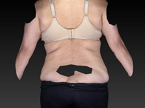 Coolsculpting Before & After