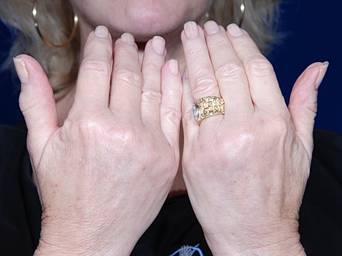 Hand Rejuvenation Before & After