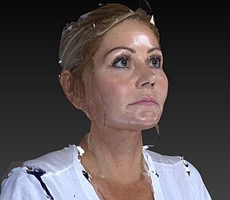 Eyelid Lift Before & After