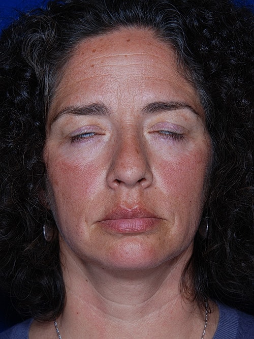 Eyelid Lift Before & After