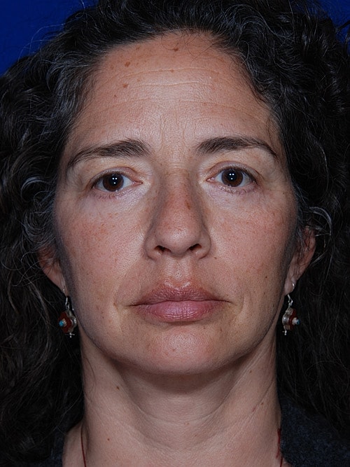 Eyelid Lift Before & After
