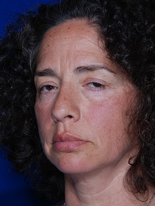 Eyelid Lift Before & After