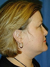 Eyelid Lift Before & After