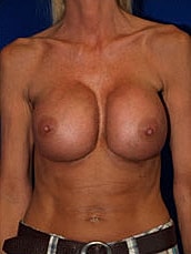Revisional Breast Augmentation Before & After