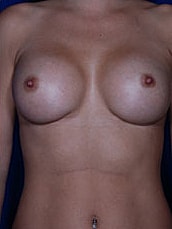 Revisional Breast Augmentation Before & After