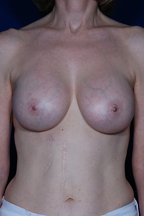 Revisional Breast Augmentation Before & After