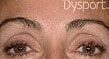 Botox Before & After
