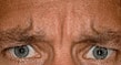 Botox Before & After