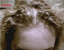 Hair Re Growth Before & After
