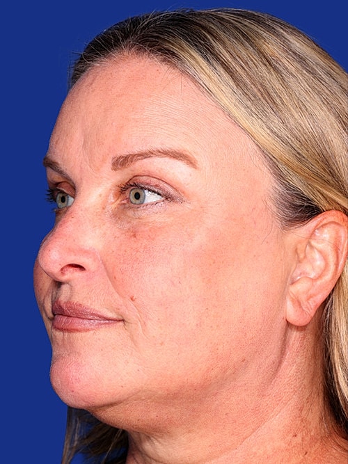 Skin Resurfacing Before & After