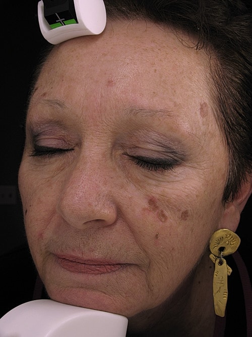 Skin Resurfacing Before & After