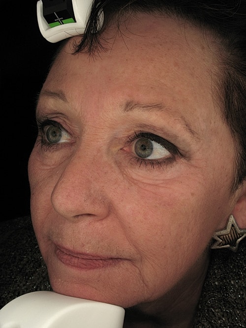 Skin Resurfacing Before & After