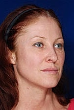 Skin Resurfacing Before & After