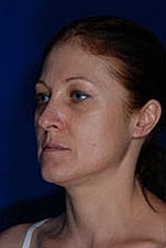 Skin Resurfacing Before & After