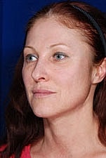 Skin Resurfacing Before & After