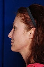 Skin Resurfacing Before & After