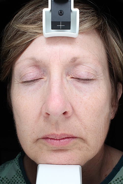 Skin Resurfacing Before & After