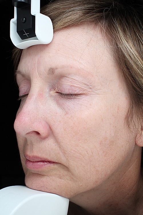 Skin Resurfacing Before & After