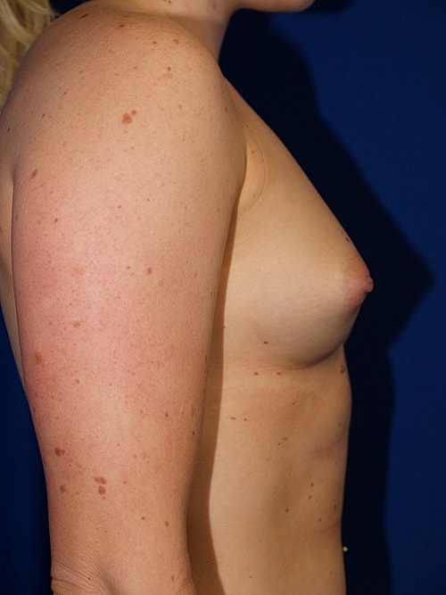 Breast Augmentation Before & After