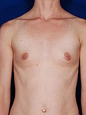 Breast Augmentation Before & After