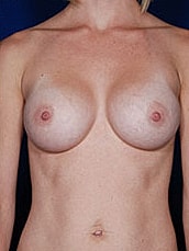 Breast Augmentation Before & After