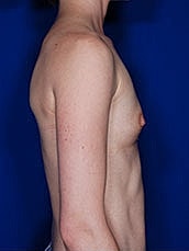 Breast Augmentation Before & After