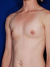 Breast Augmentation Before & After