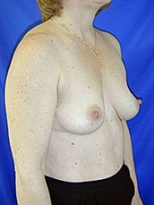 Breast Augmentation Before & After