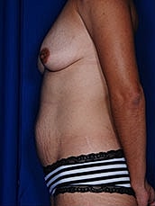 Breast Augmentation Before & After