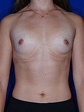 Breast Augmentation Before & After