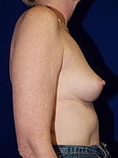 Breast Augmentation Before & After