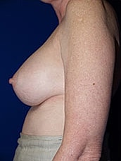 Breast Augmentation Before & After