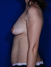 Breast Augmentation Before & After