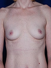 Breast Augmentation Before & After