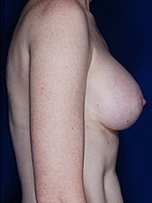 Breast Augmentation Before & After